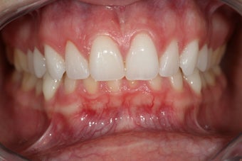 Invisalign