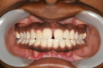 Invisalign