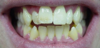 Invisalign