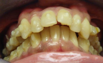 Invisalign Treatment 