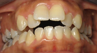 Invisalign performed 