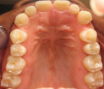 Invisalign 