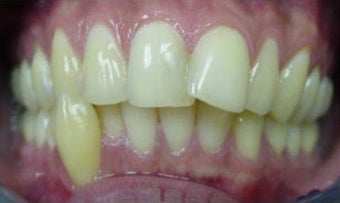 Invisalign 