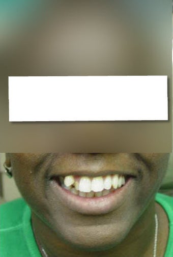 Invisalign