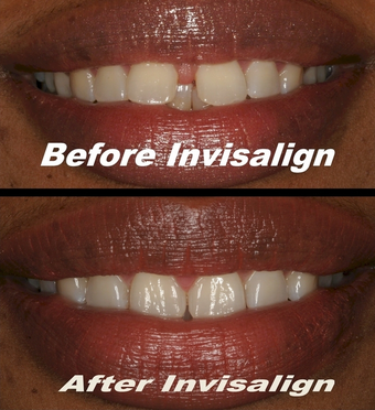 Invisalign