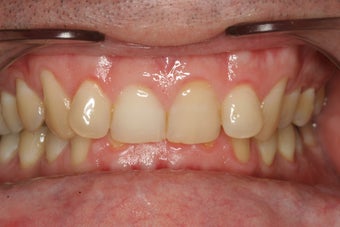 Invisalign Treatment