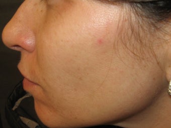 Isolaz treatment