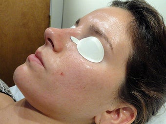 Acne Treatment via Isolaz
