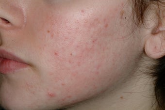 Acne and Isolaz