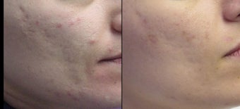 Aesthera Isolaze for acne