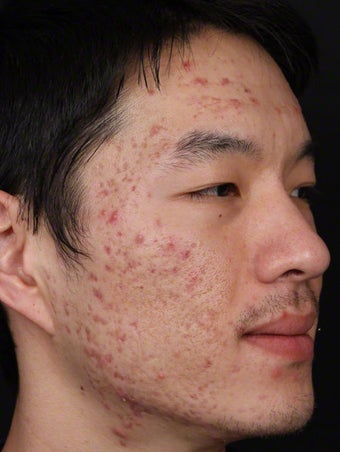 Isolaz for Acne