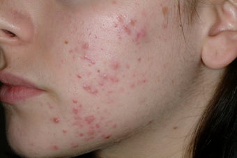 Acne and Isolaz