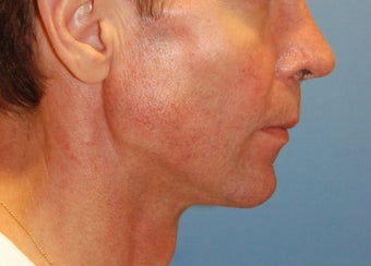 Jaw Augmentation with Mandibular Implants