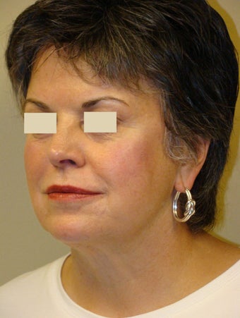 Juvederm Injections for midface