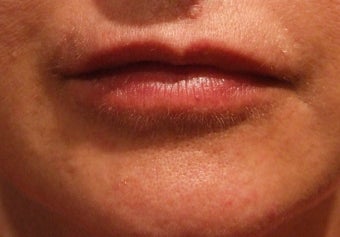 Lip Augmentation