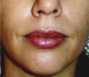 Lip Augmentation with Juvederm