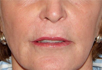 Juvederm for Lip Border and Lip Lines