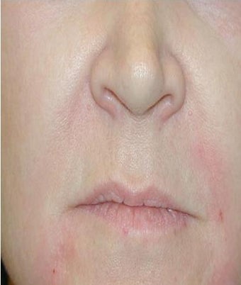 Juvederm