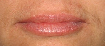 Juvederm to Lips