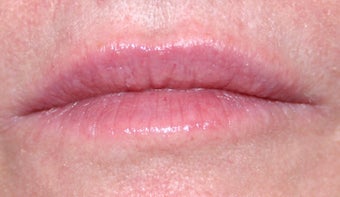 Juvederm and Botox to lips