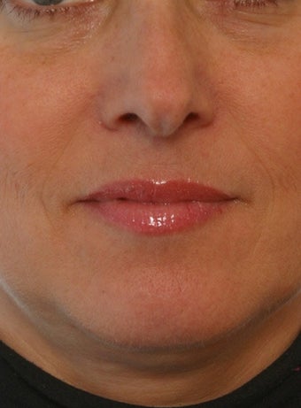 Juvederm