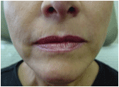 juvederm