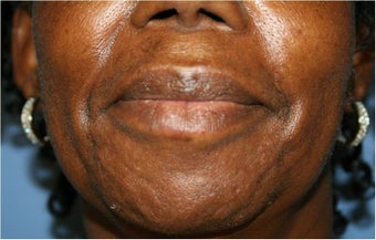 Lip augmentation with Juvederm