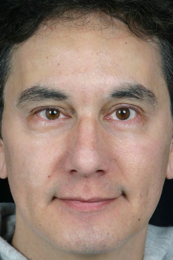 Pearl, Botox and Juvederm to Glabella (between eyes)