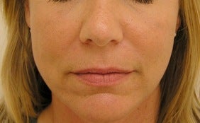 Juvederm