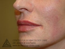 Juvederm Injection to Augment Lip Line