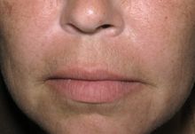 Juvederm