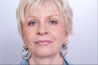 Juvederm Injection