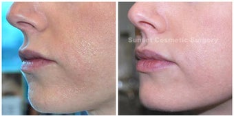 Juvederm: Subtle Lip Enhancement