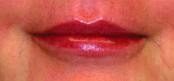 Lip augmentation