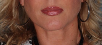 Lip Augmentation with Juvederm