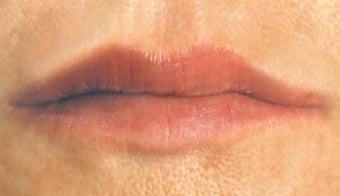 Lip enhancement