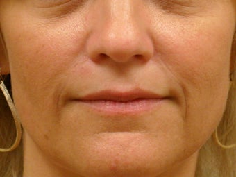 Treatment of prominent nasolabial folds with dermal filler