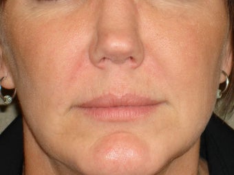 Treatment of prominent nasolabial folds with a dermal filler