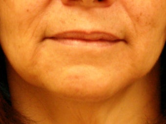 Treatment of marionette lines with a dermal filler