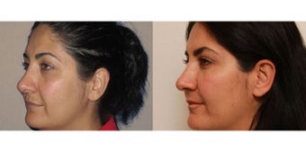 Facial Rejuvenation, non-surgical