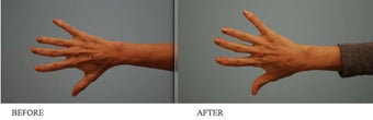 Juvederm to hands