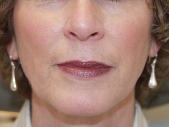 Juvederm