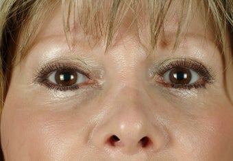 under eye fillers