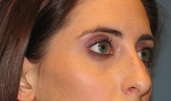 Tear Trough Filler