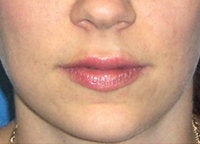 Juvederm Lip Enhancement