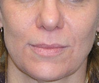Volume Filler to Nasolabial Folds and Eye region