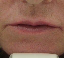 63 year old lip Augmentation with Juvederm