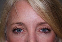 Juvederm & Botox