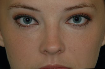 Juvederm injected under the eyes