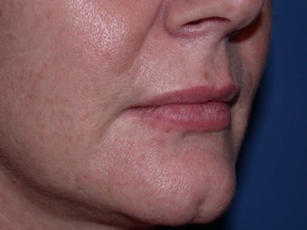Before and After Lip Juvederm